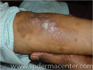 Psoriasis-Treated